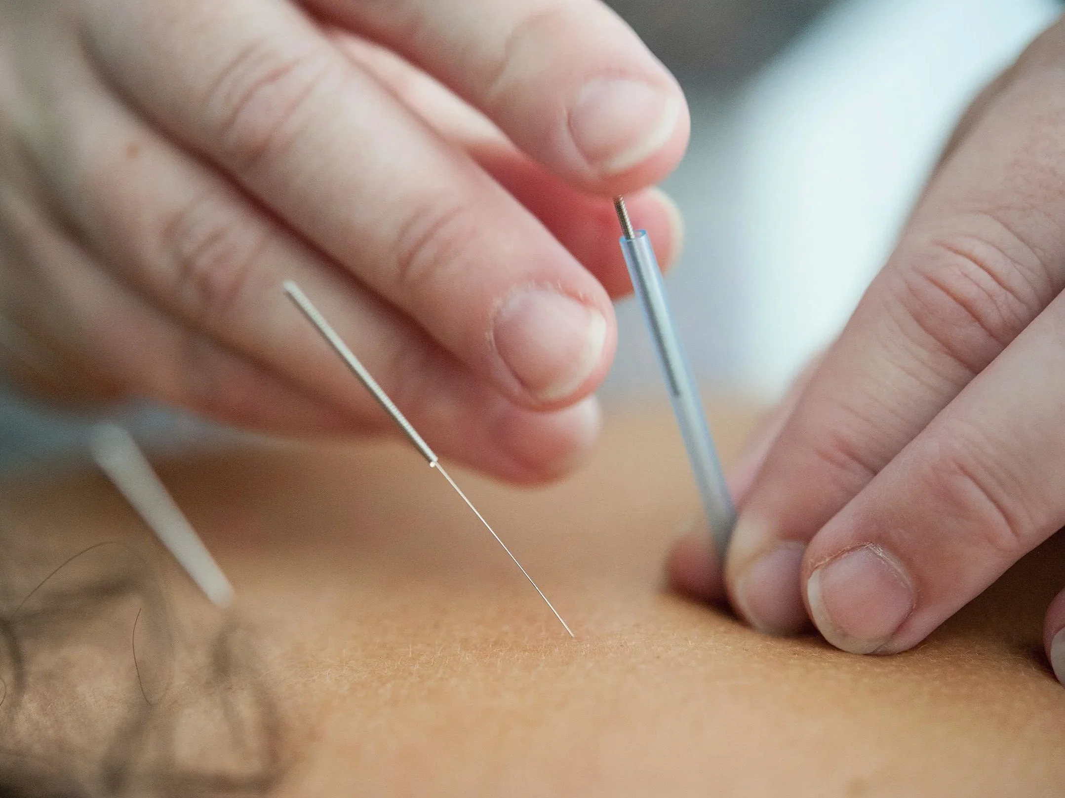 Is Dry Needling Effective for Muscle Pain?