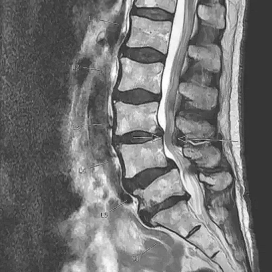 ‘Hyperactive’ Stem Cells May Cause Spinal Stenosis