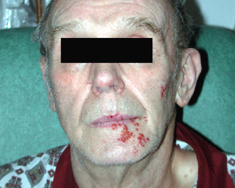 Damaged Nerve Cells May Cause Painful Shingles Rash&nbsp;