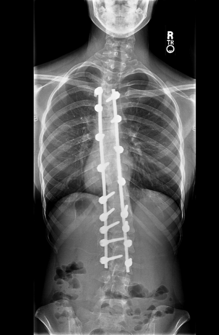 Deflated Spines How the Curves in Your Spine Cause Back Pain — Pain News Network