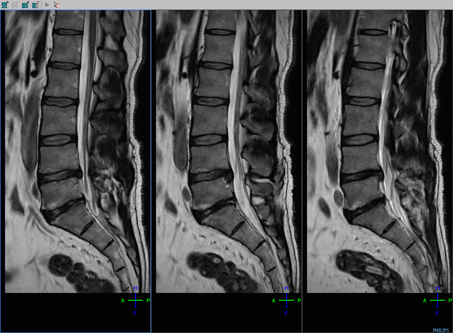 Spine L SAG  post-op T2 (2).png