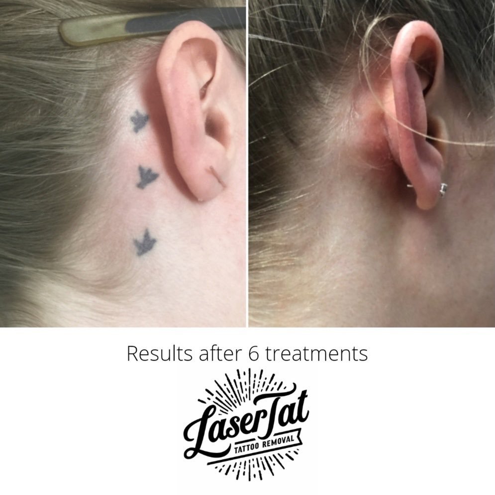 Black Diamond Tattoo - LaserTat Adelaide Tattoo Removal & Fading