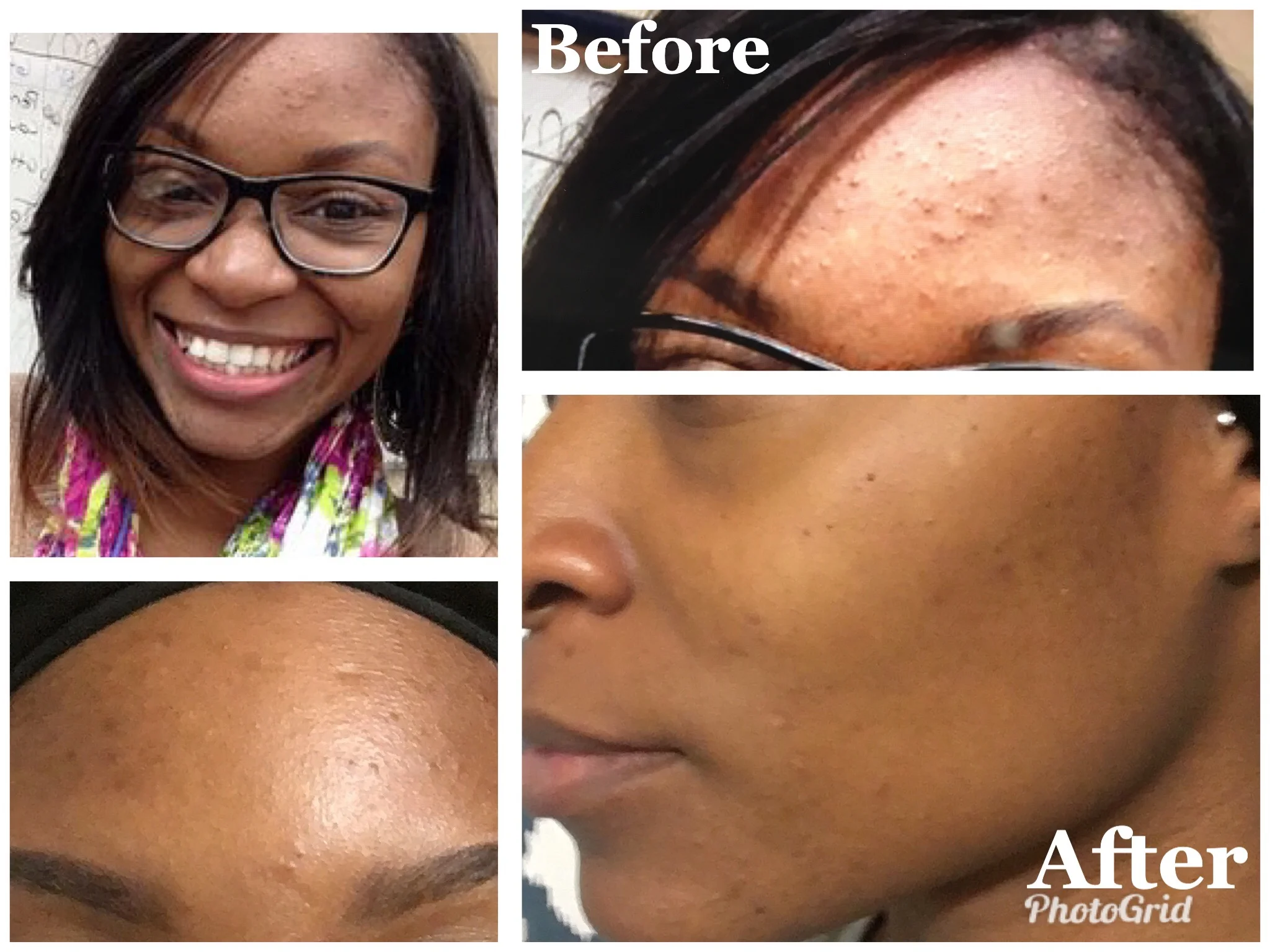 Adult Acne and Microdermabrasion with a peel