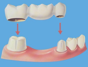 Dental-Bridge.png