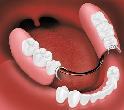 Partial_Denture_1.jpg
