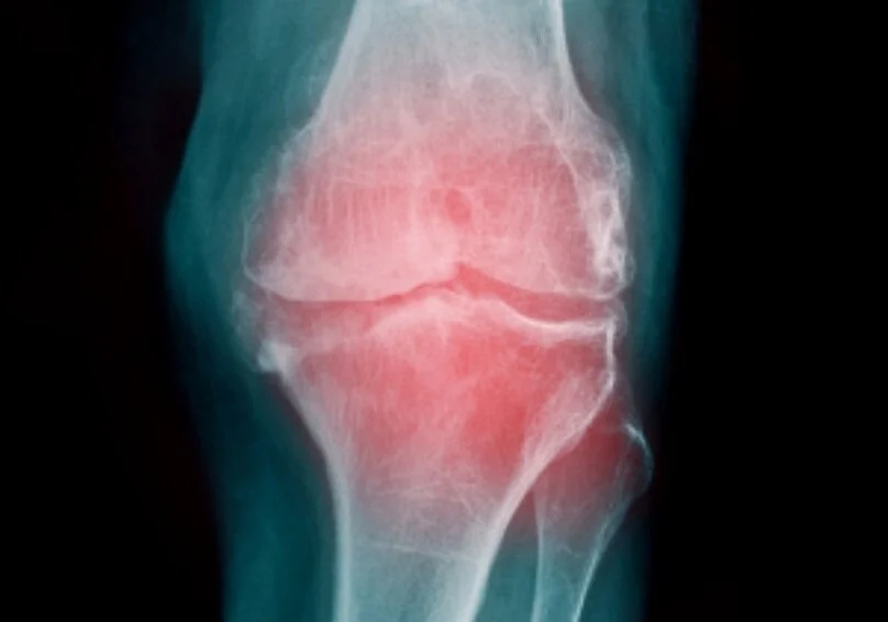 Episode 293 - David Hunter, part 2: Osteoarthritis