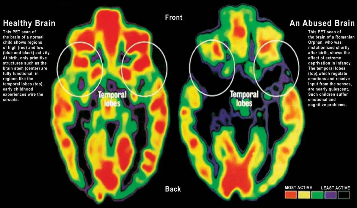 A PET scan showing the impacts of traumatic events on children's brain.