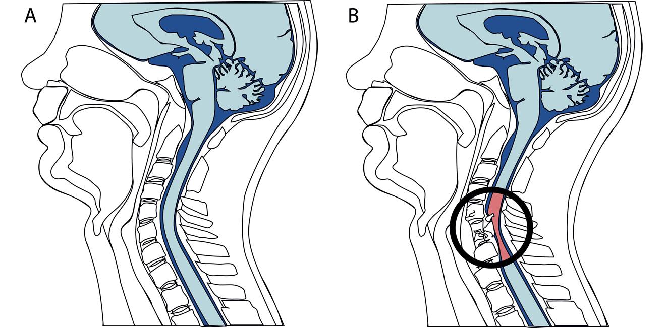 Cervical Spinal Cord Injury