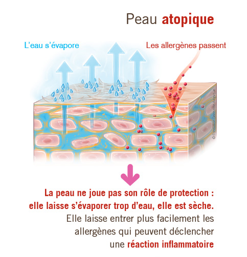 Fondation dermatite atopique*