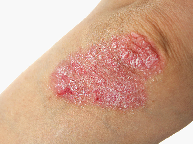 Psoriasis coude crédit photo*