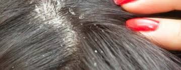 Pellicules cheveux