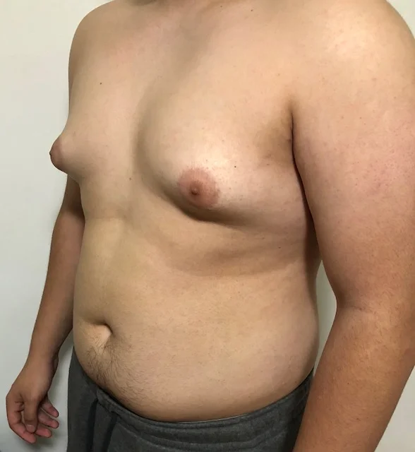Image of Jason’s chest (pre-surgery)