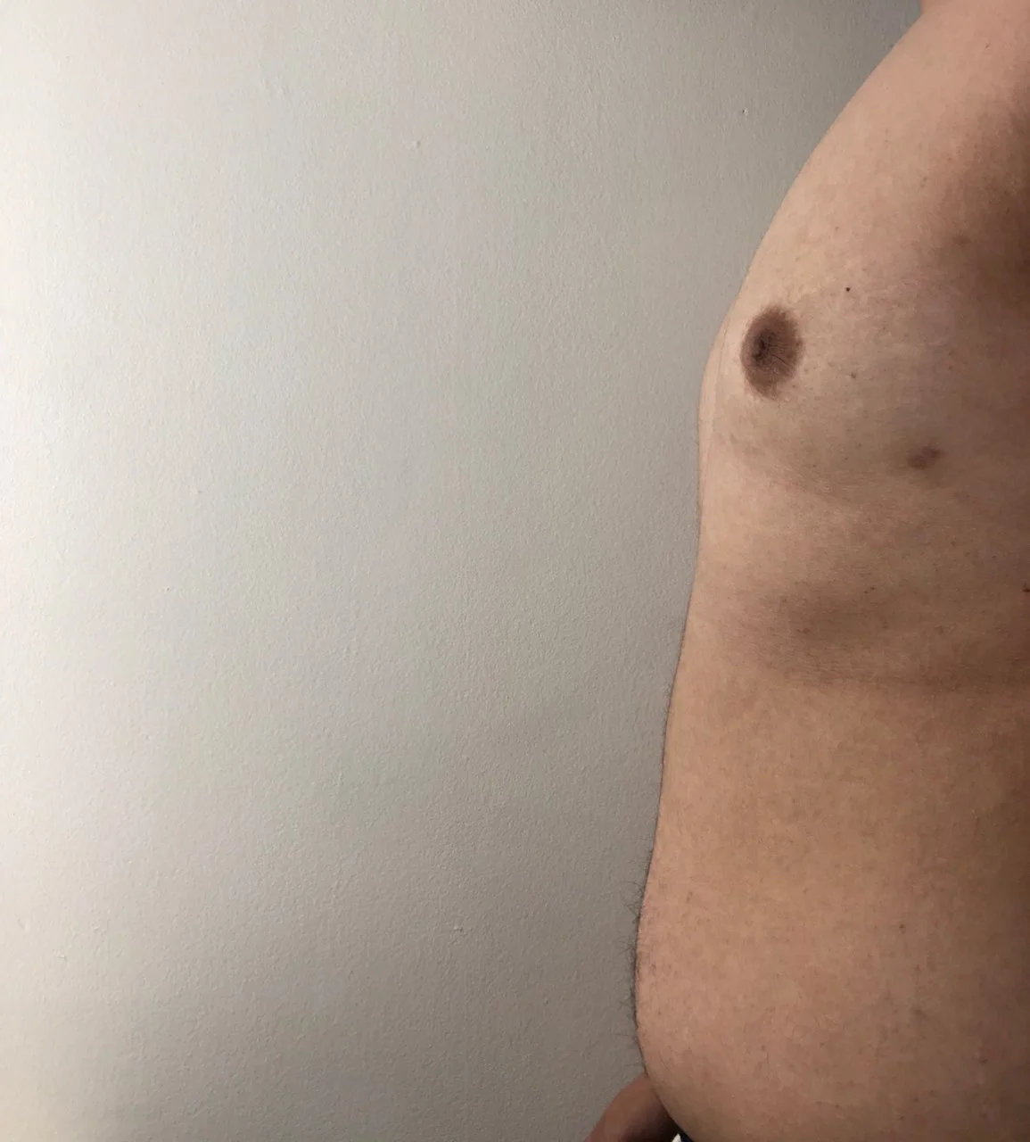 Image of Jason’s chest (five weeks post-surgery)