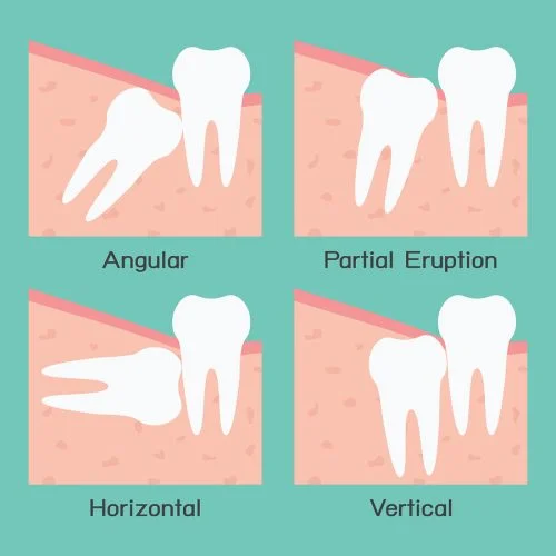bigstock-Wisdom-Tooth-48093035.jpg
