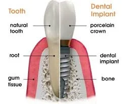 Do you need a Dental Implant?