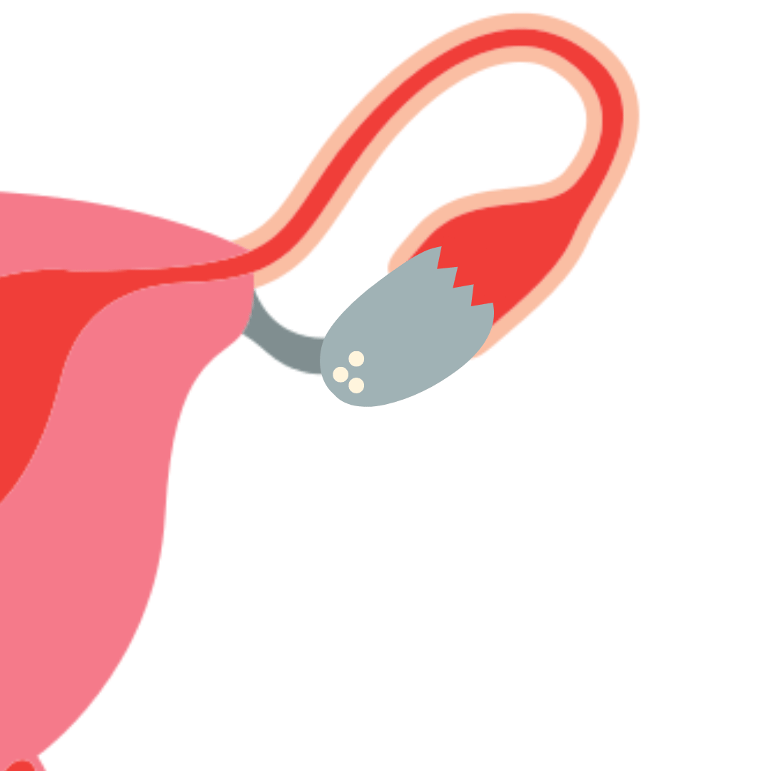 PCOS cyst formation animation.gif