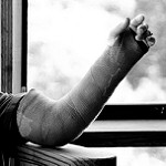 Broken Arm Photo by James Lee under CC BY 2.0