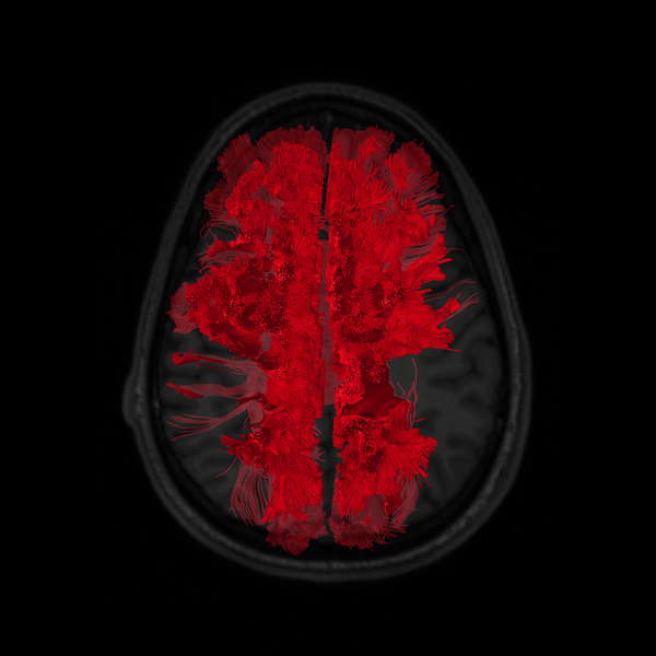 Brain Tracts — TEAM TBI