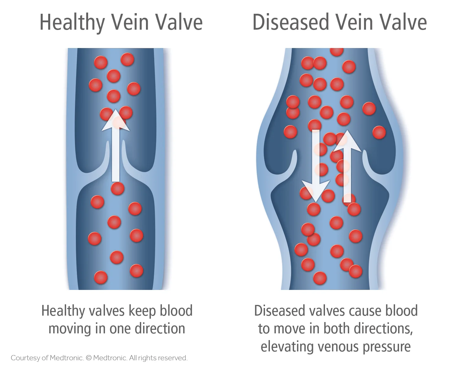 Healthy-vs.-Diseased-Vein-Valve-2-Illustration.jpg