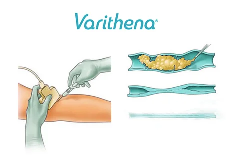 Varithena-Endovovenous-Chemical-Ablation-with-Foam.jpg