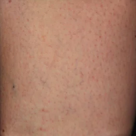 Patient A - After Asclera
