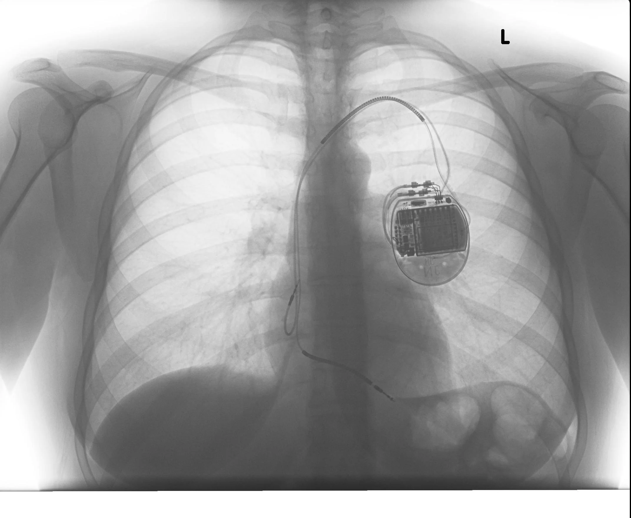 ICD-kes.jpg