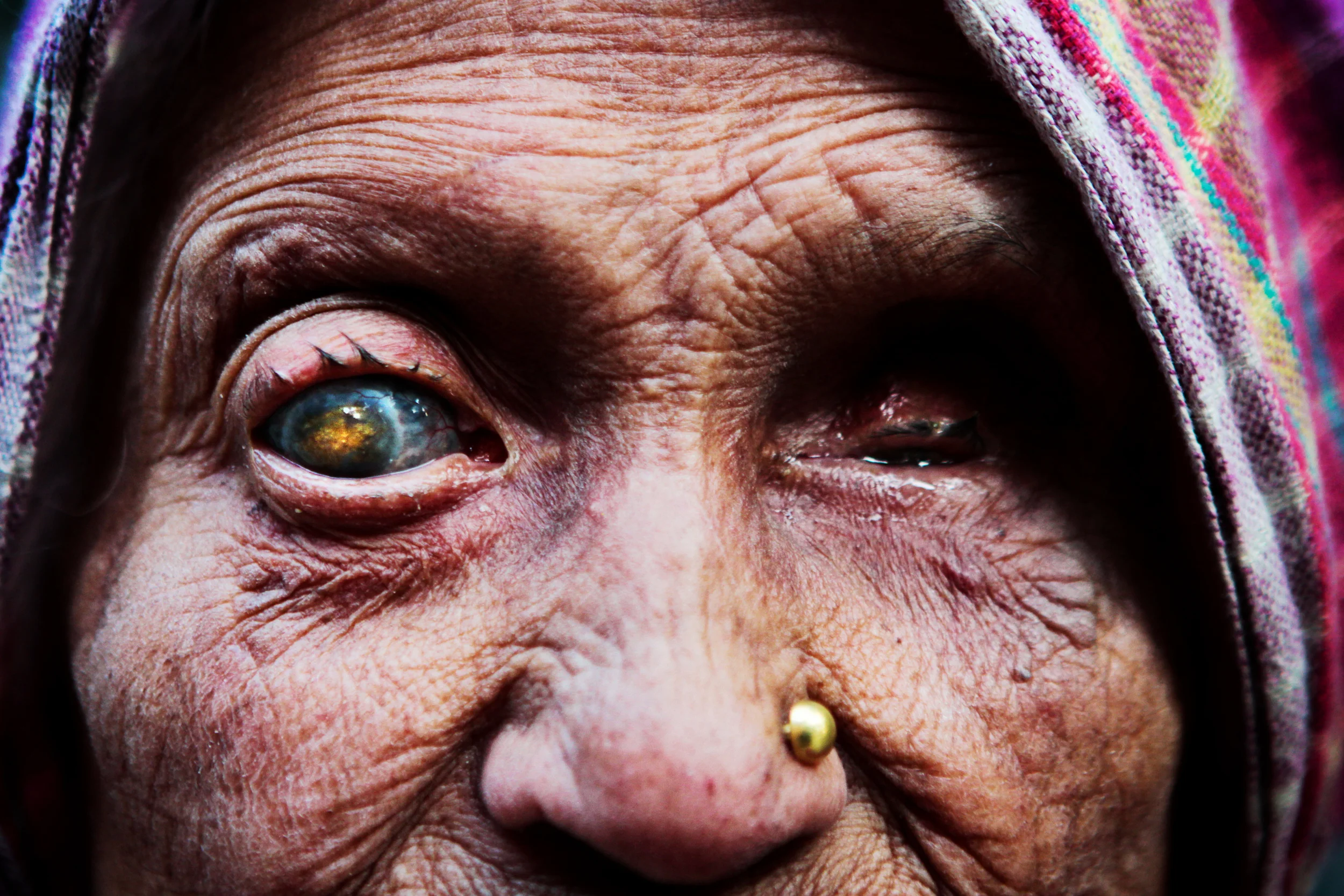  For centuries, Leprosy or Hansen's disease has been a disease both feared and misunderstood. In many societies - even after the biological cause of the disease was discovered - those with Leprosy are shunned and stigmatized. In India, Leprosy was co