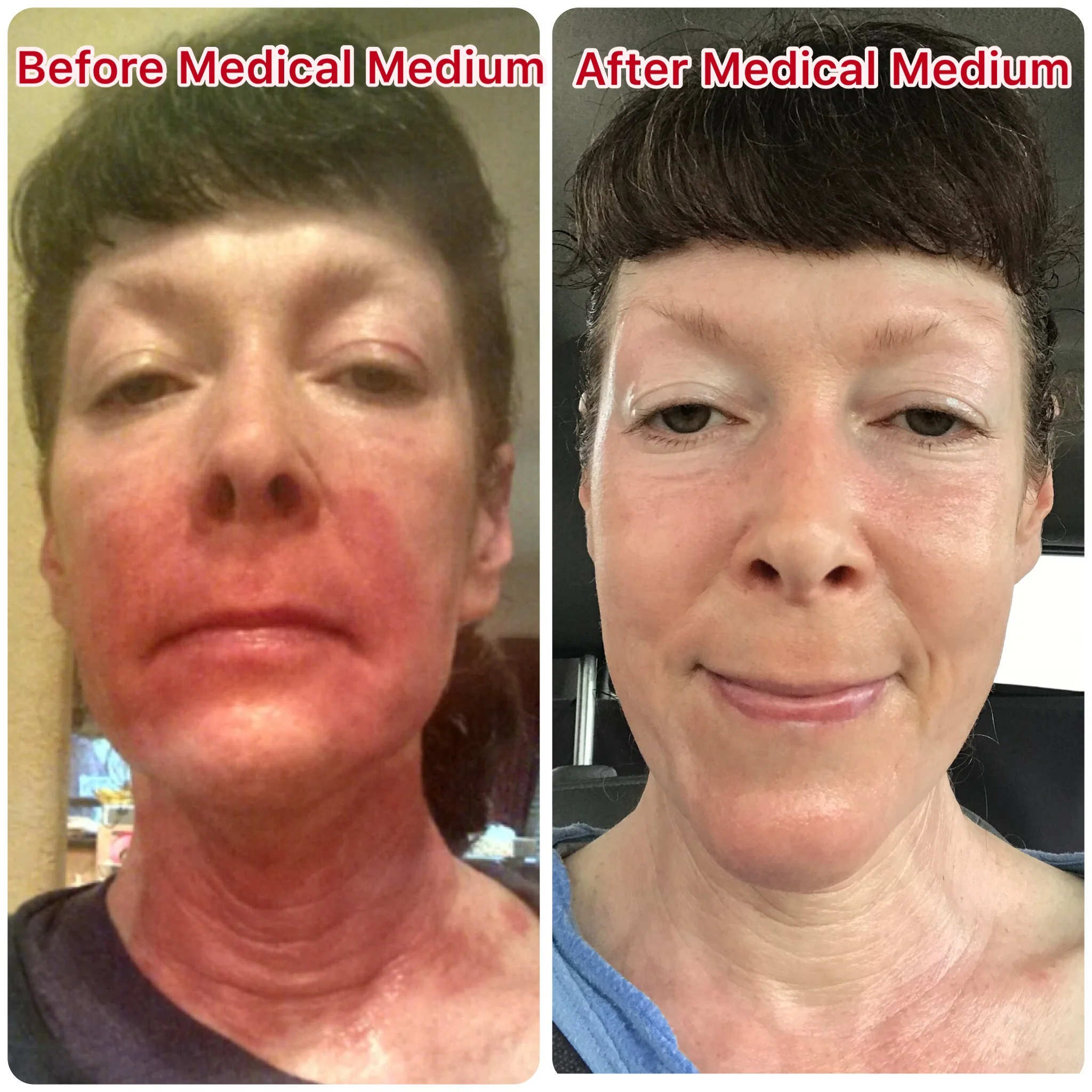 Adventures In Healing Samantha Beats Eczema And Chronic Fatigue With