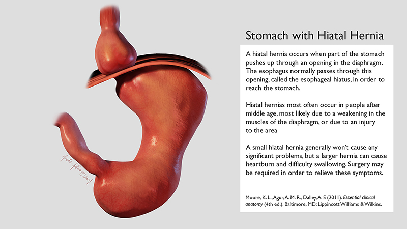 Stomach with Hiatal Hernia