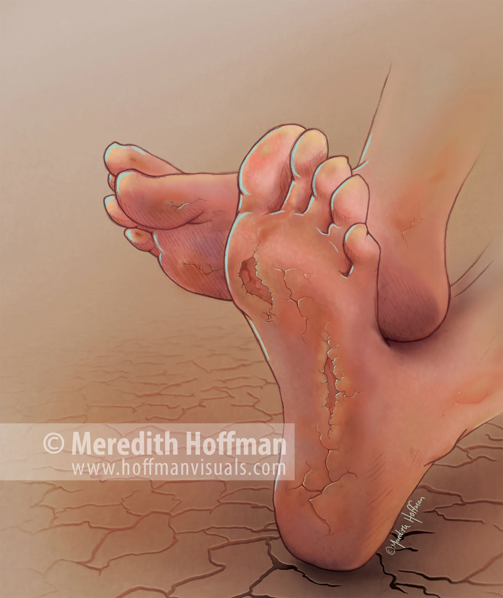 Eczema of the foot
