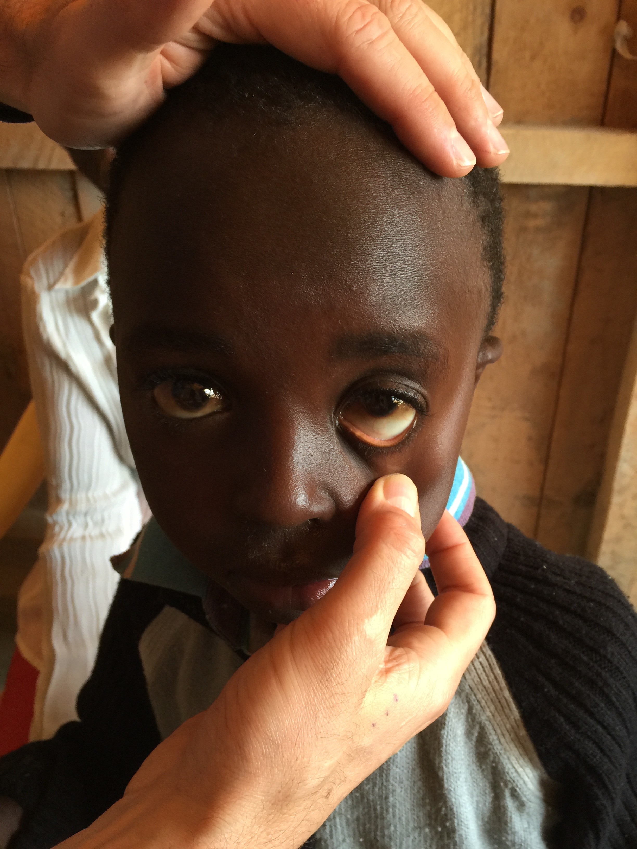 A little boy whose eyes are suffering from the smoke effects of having an open wood fire used for cooking in the house. 