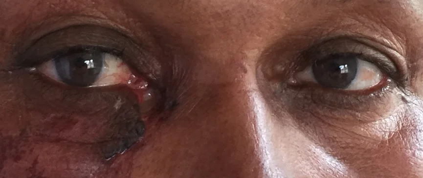 A patient escaped 5 elephants but fell and hit his eye on a rock in the process. 