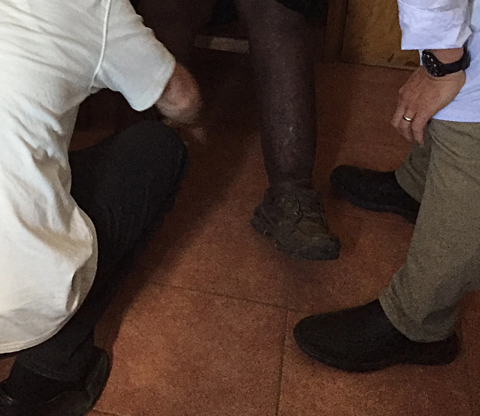 This case of bilateral swollen lower legs had become so severe that the patient was having trouble walking and was avoiding social interaction