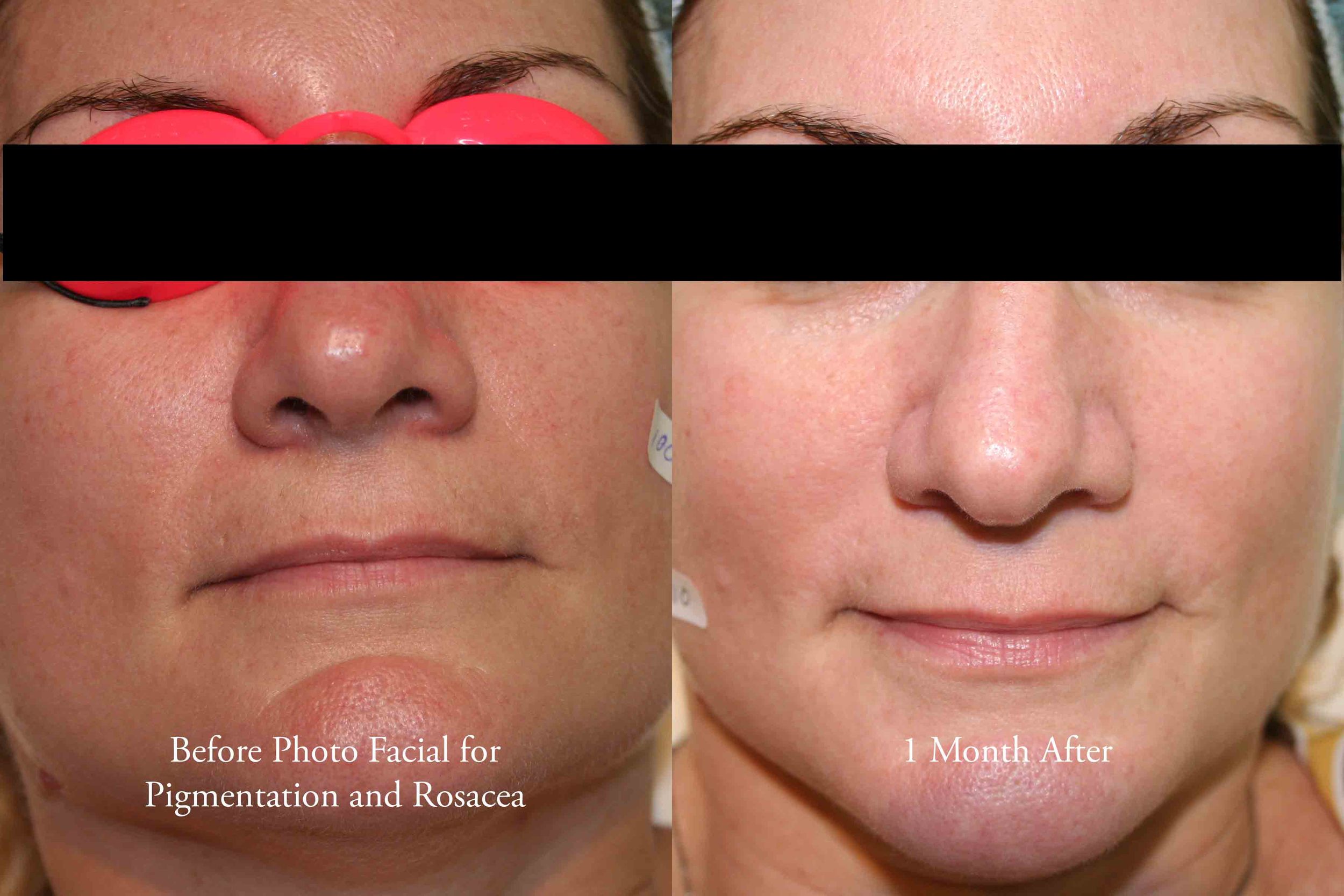 photo facial for rosacea and pigmentation 1 - web.jpg