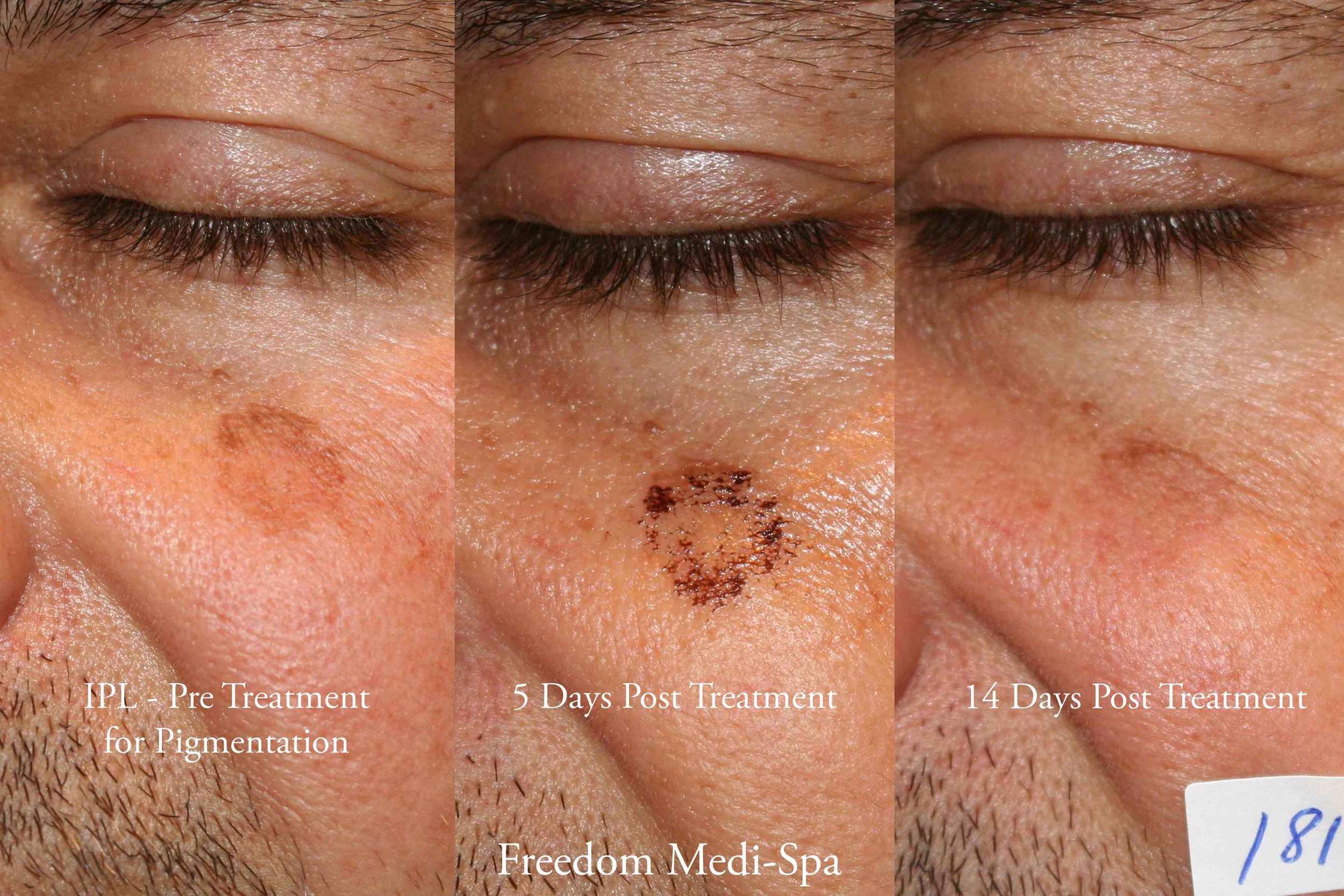 ipl---pigmentation.jpg
