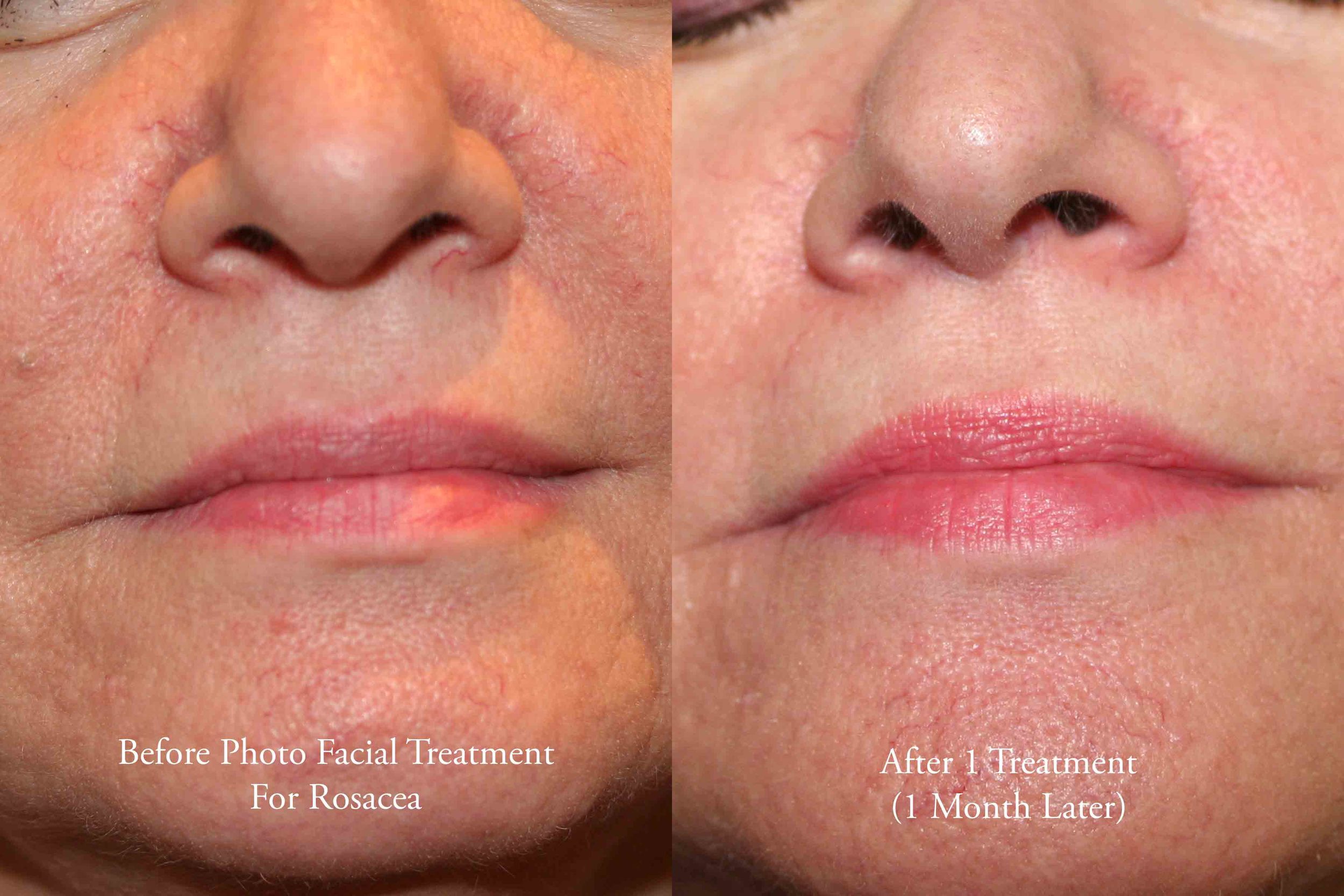 photo facial for rosacea 1 - web.jpg