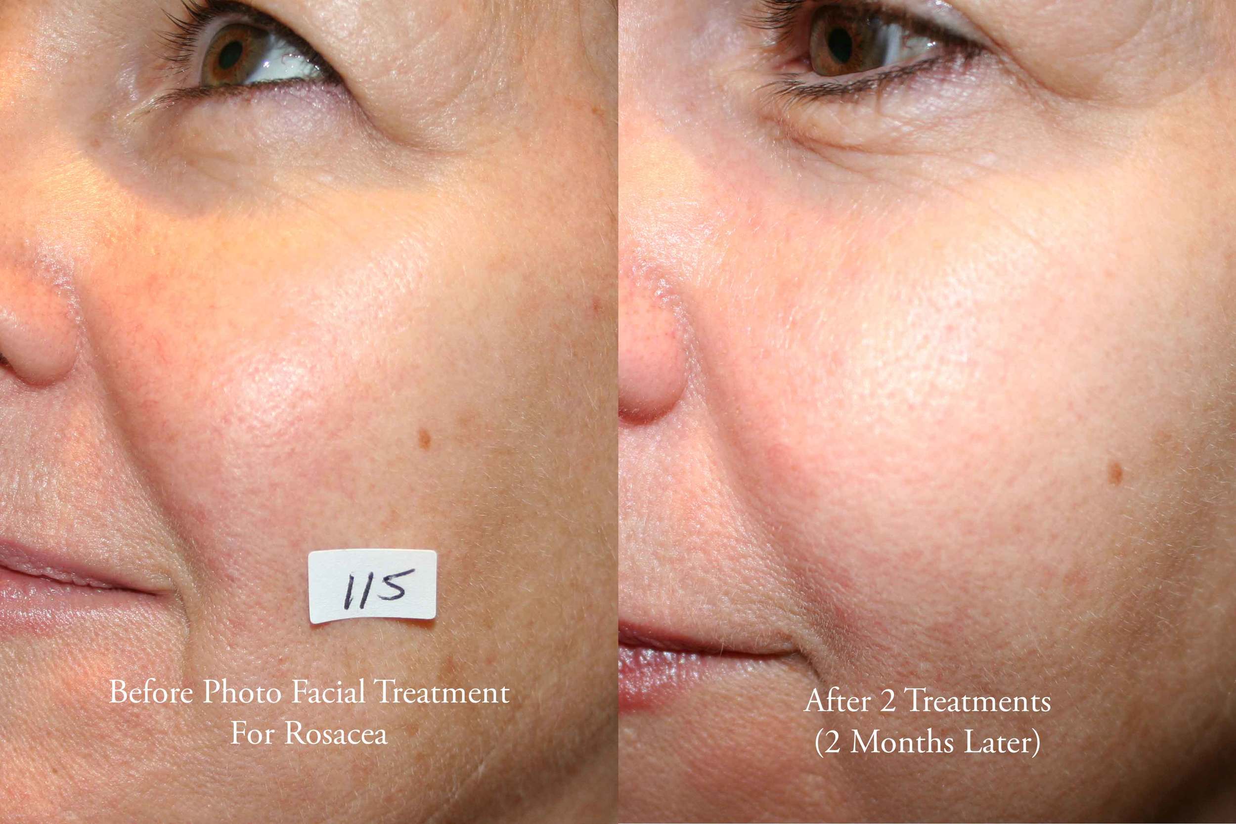 photo facial for rosacea 2.jpg