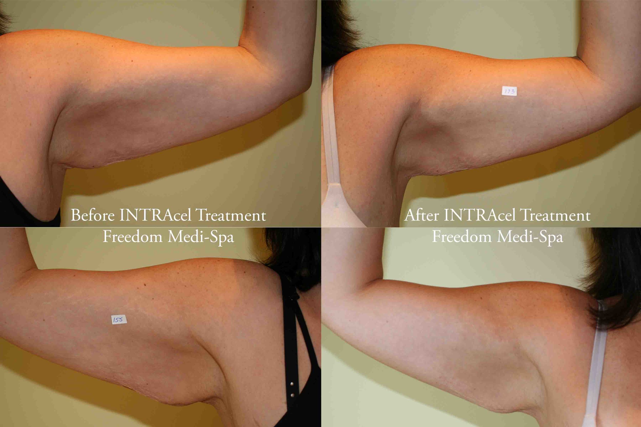 Intracel Before and After Arms Treatment.jpg