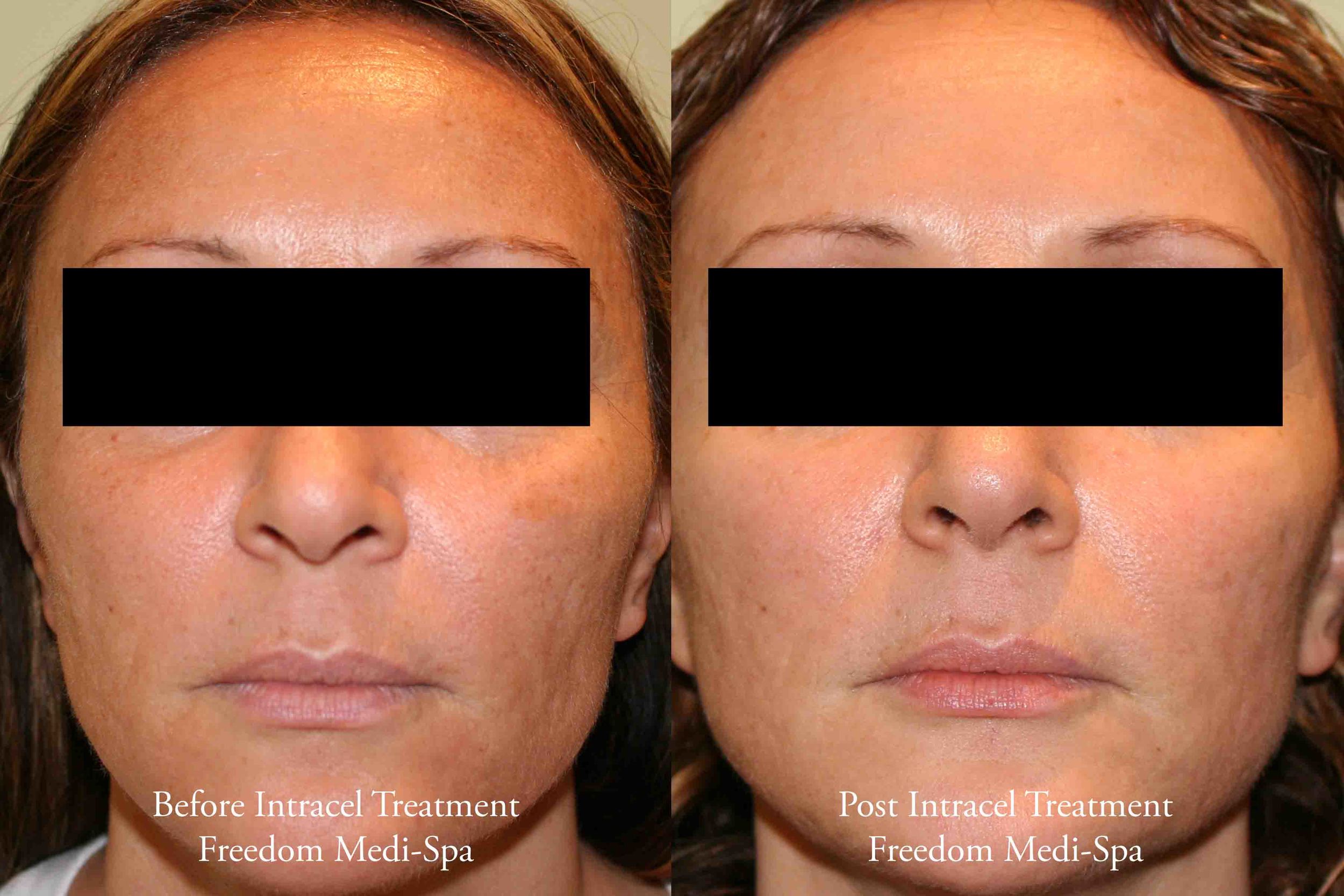 Intracel Before and After Acne Scars front.jpg