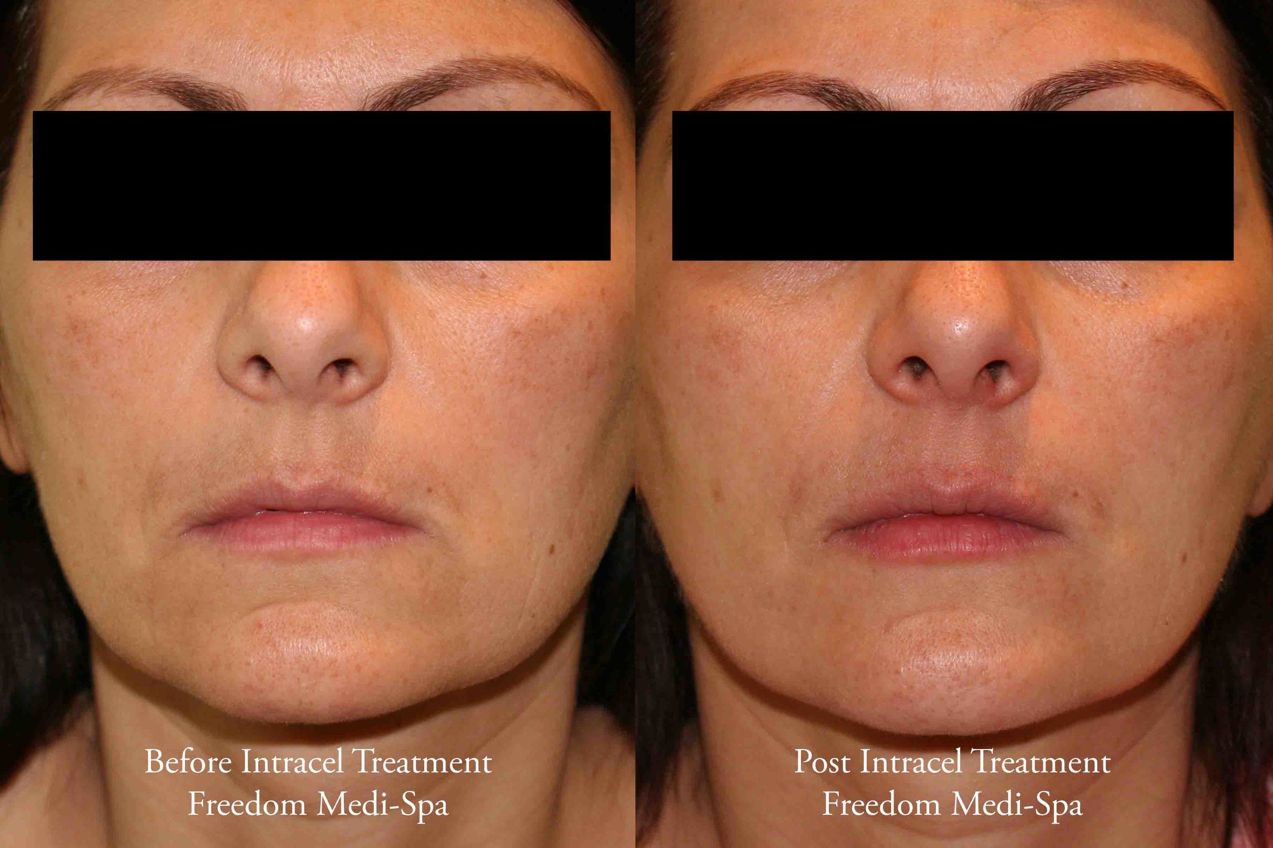 Intracel Before and After Skin Tightening_edited-1.jpg