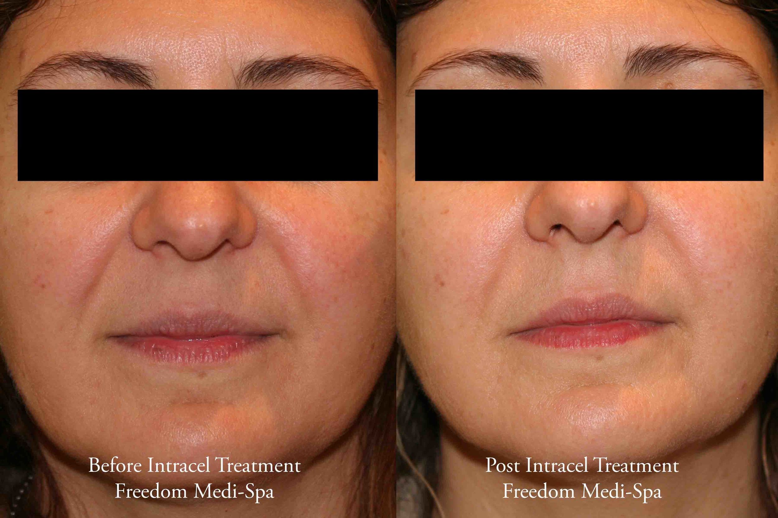Before and After - Intracel Treatment May 2015.jpg