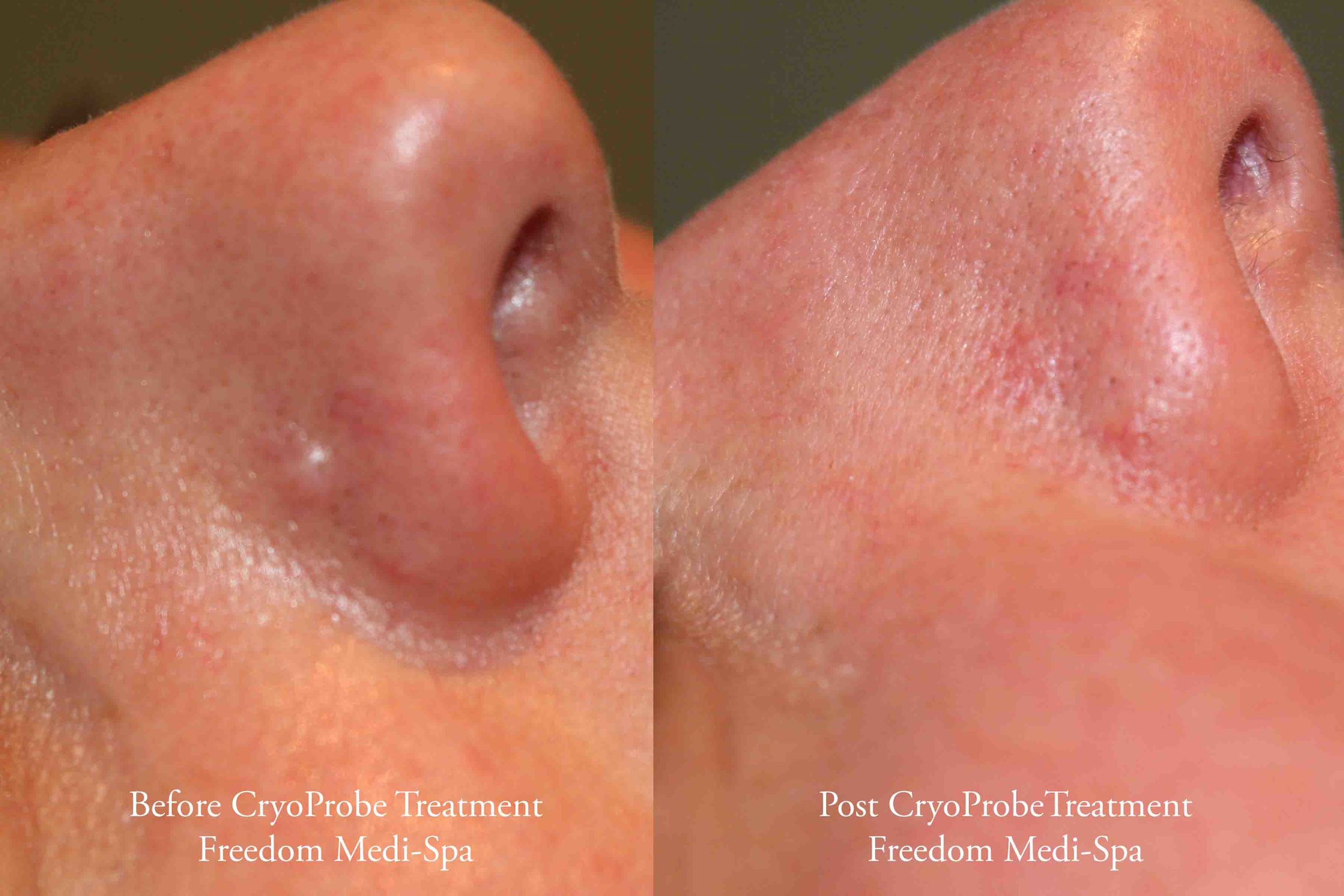 CryoProbe Before and After Benign Mole.jpg