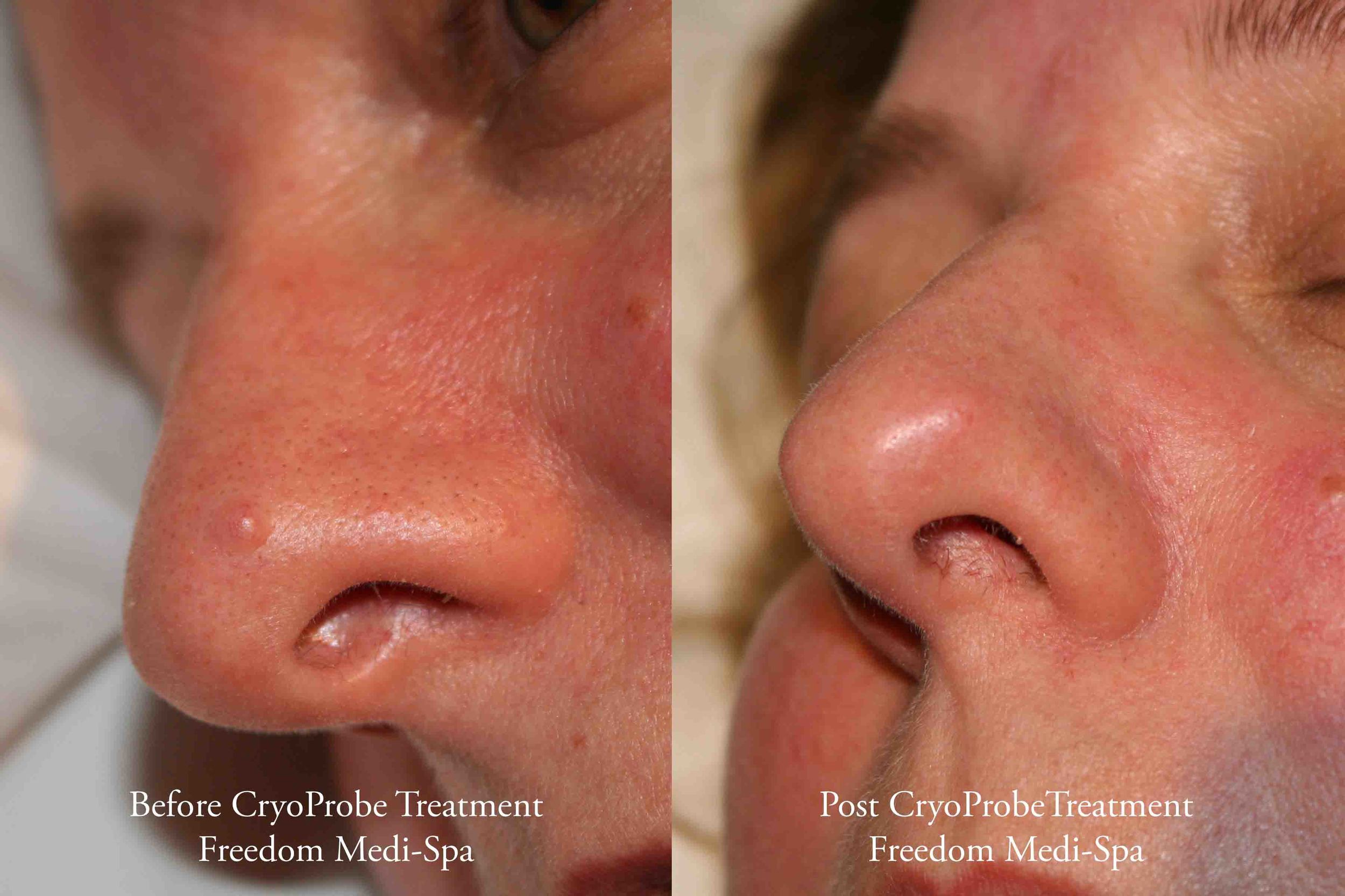 CryoProbe Before and After Benign Mole 2.jpg