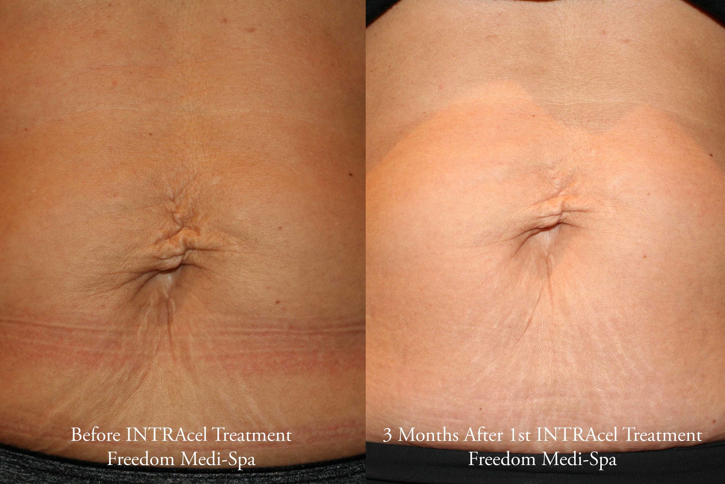 Intracel Before and After Oct 2015 Body.jpg