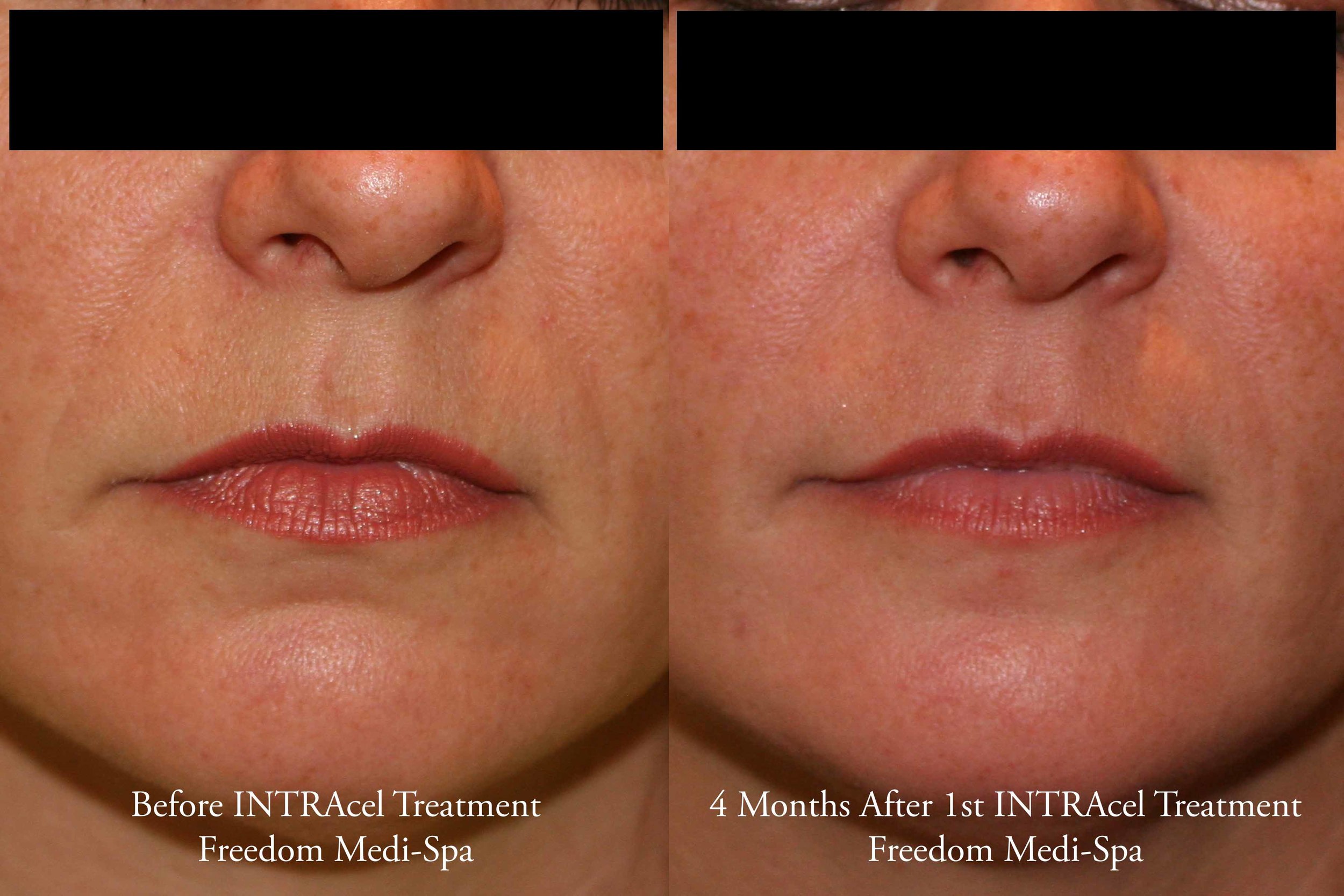Intracel Before and After Oct 2015 Nasolabial.jpg