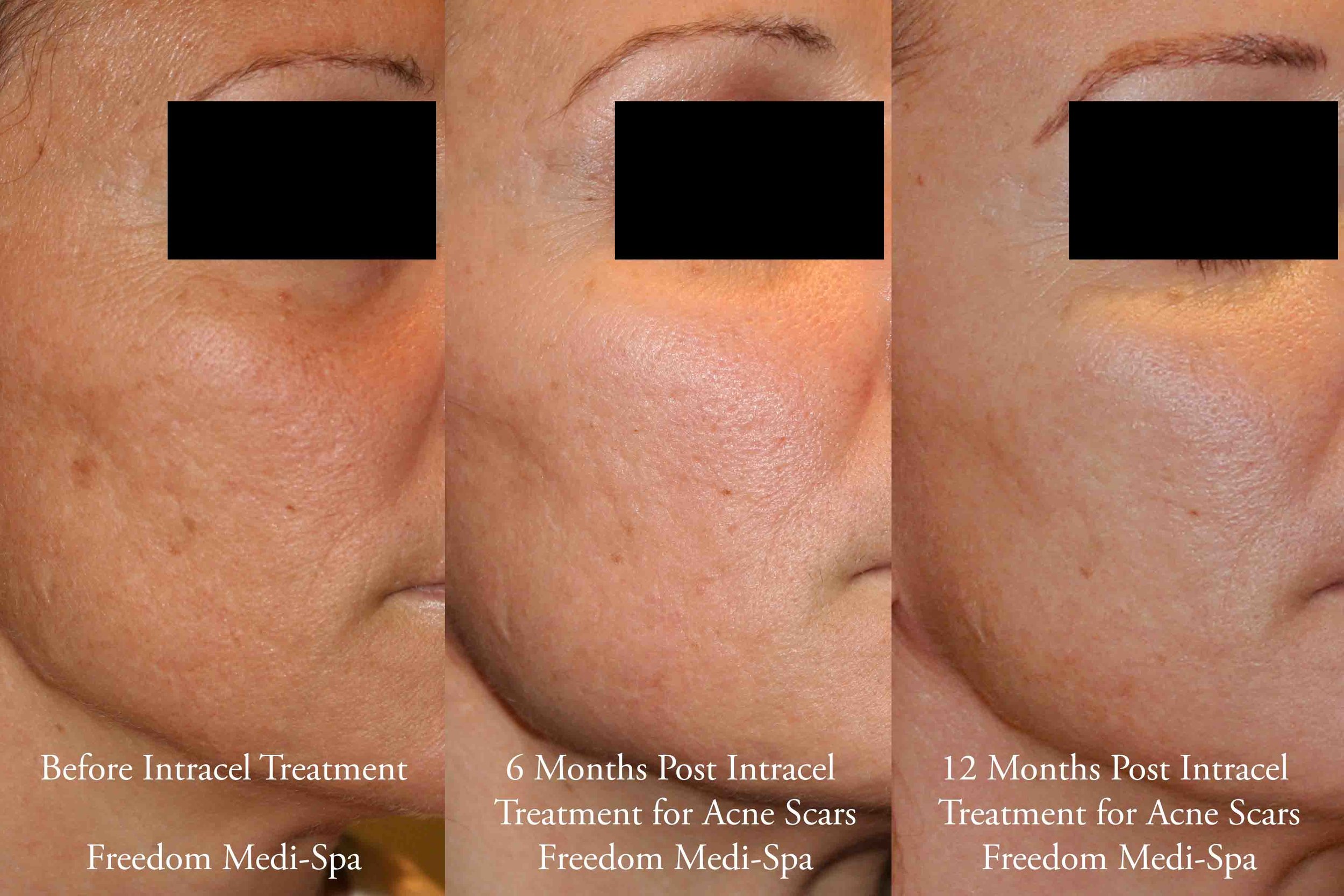 Intracel Before and After Acne Scars Nov 2016.jpg