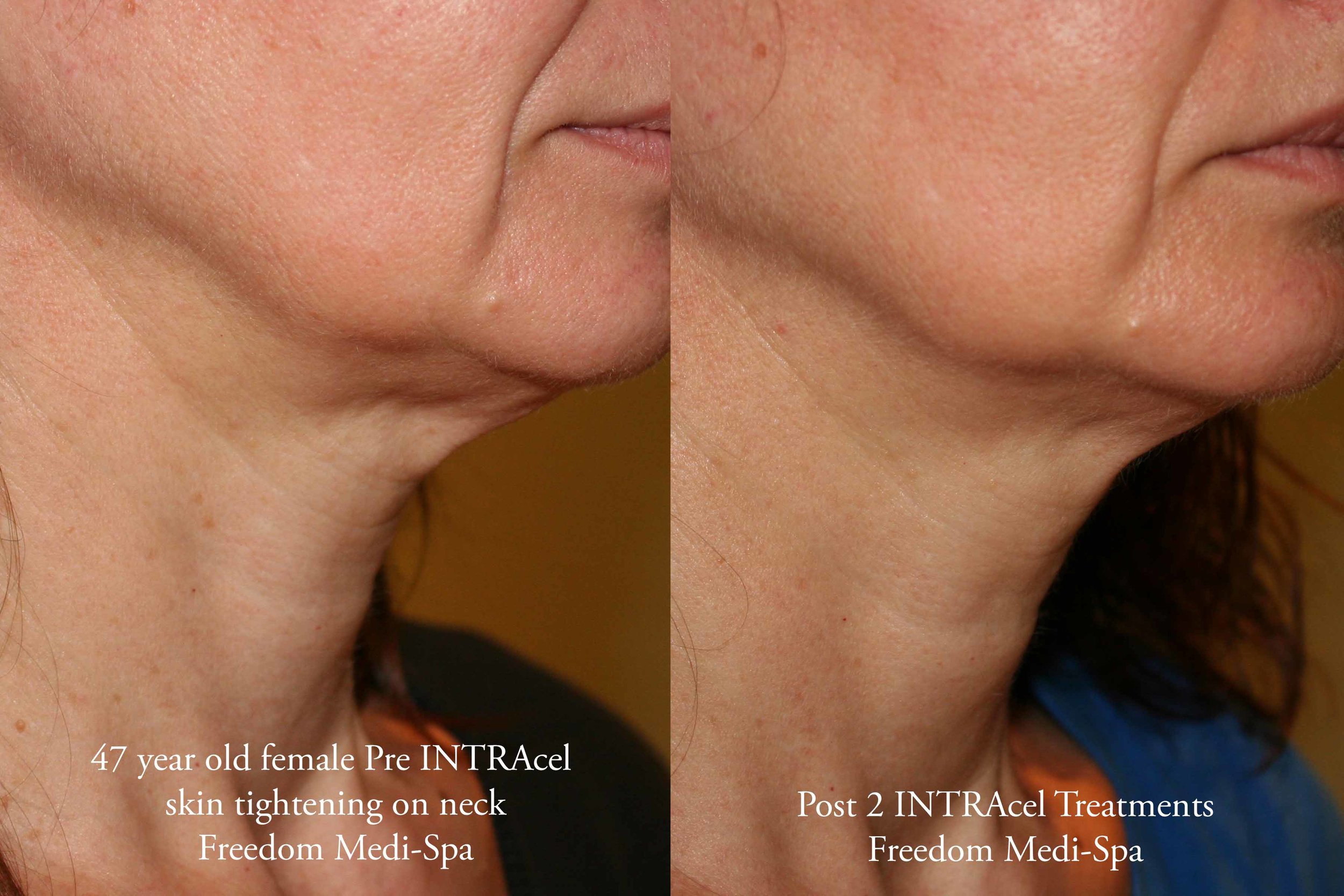 Intracel Before and After Aug 2016 Neck 2.jpg