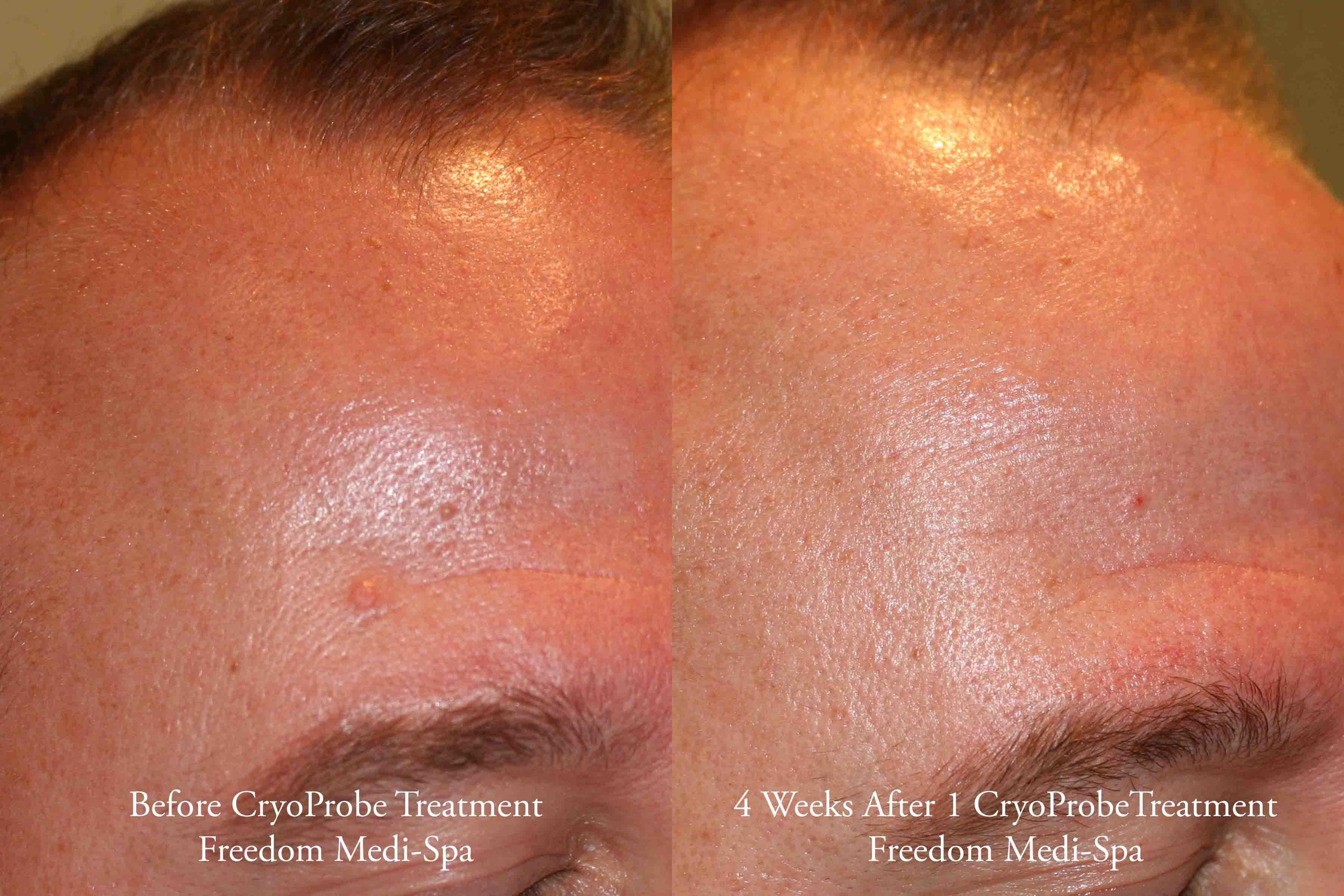 CryoProbe Before and After Nov 2016.jpg