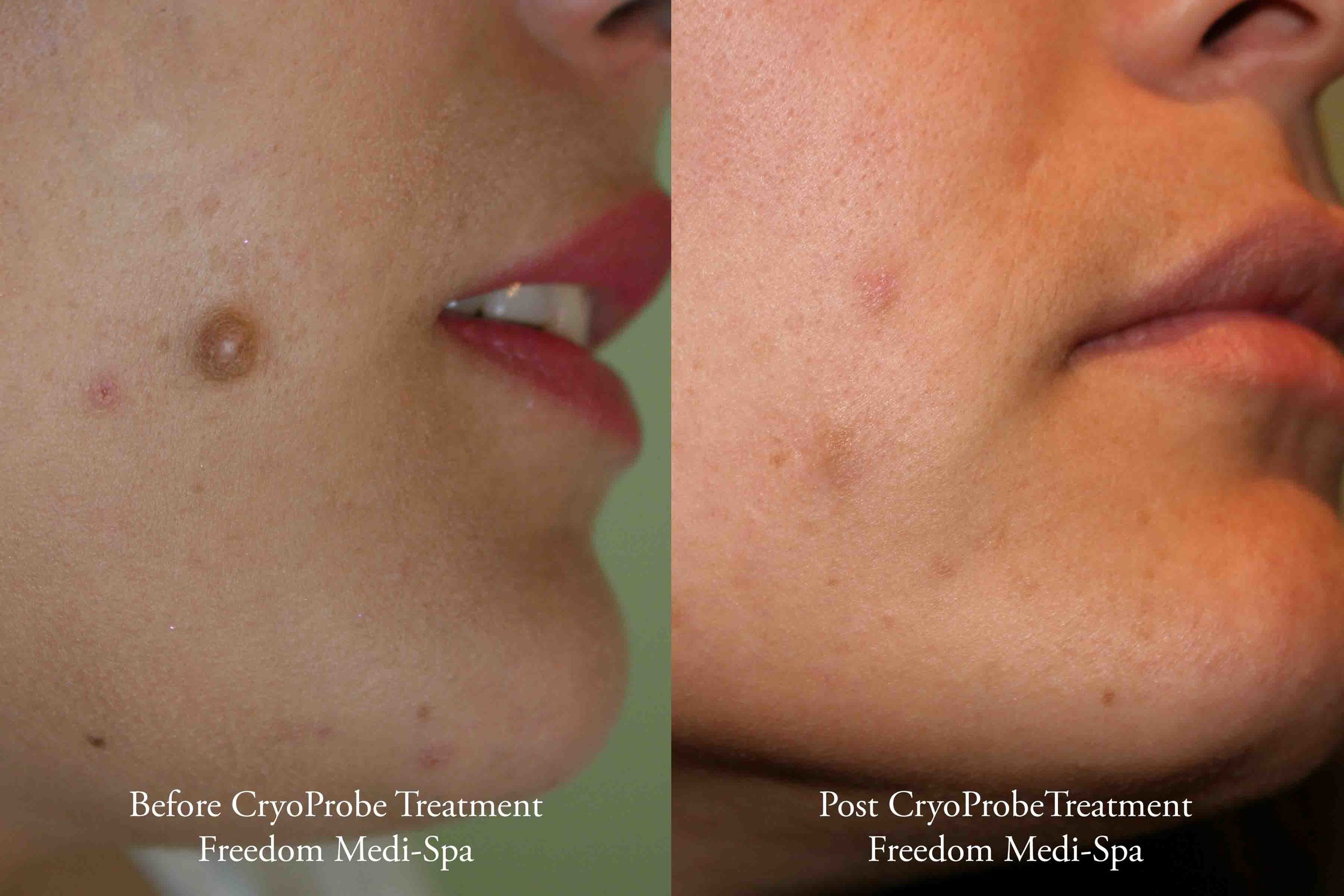 CryoProbe Before and After Oct 2015.jpg