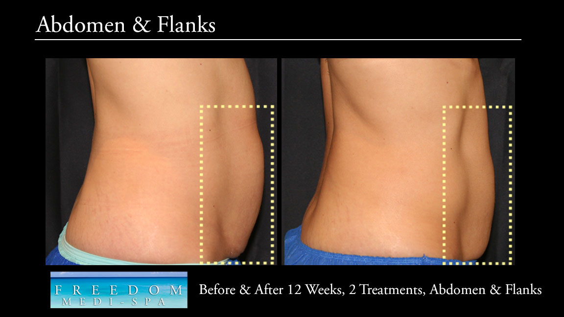 SculpSure Abs Flanks Oct 2017 5.jpg